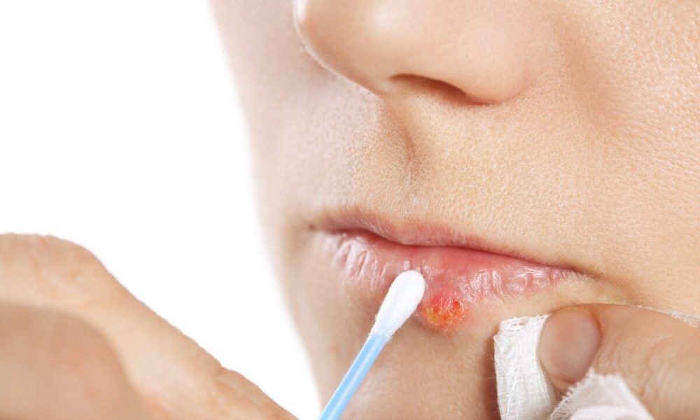 Genital Herpes Treatment Market
