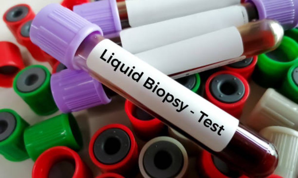 Blood samples for Liquid biopsy blood test to detect cancer cells or DNA fragments that circulate in the bloodstream, Lung cancer, laboratory background.