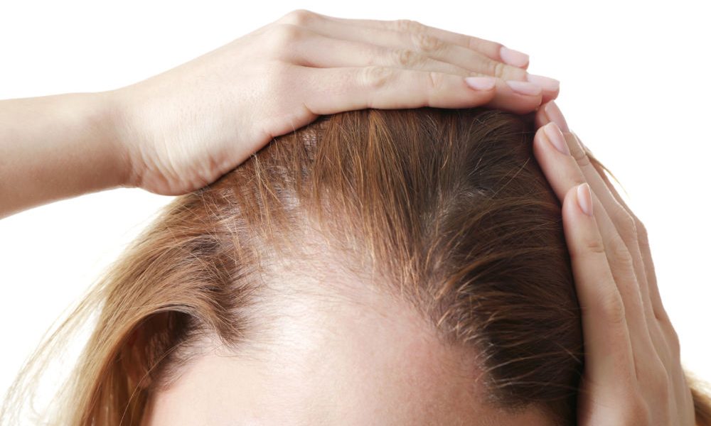 Hair Transplantation