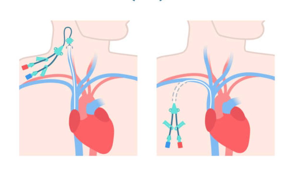 Tunneled and non-tunneled central venous catheters placed in the jugular and subclavian veins. CVC access device placement types. Medical vector illustration.