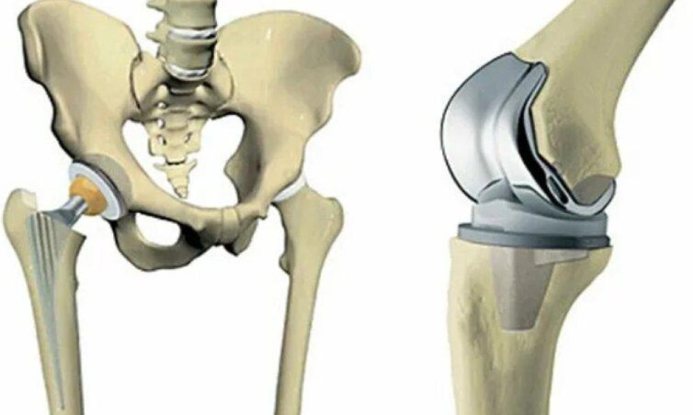 Hip Reconstruction Devices Market