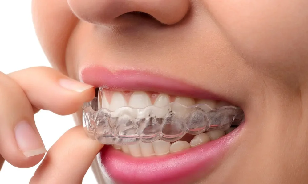 Hockey Mouthguard Market
