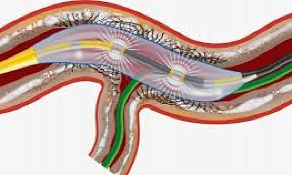 Intravascular Lithotripsy (IVL) Market
