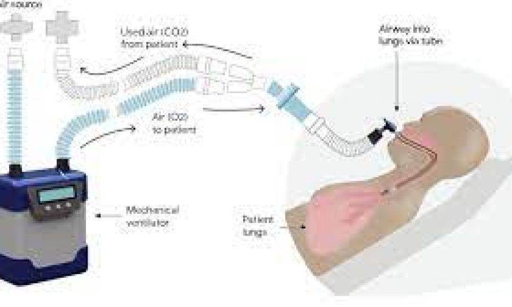Invasive Ventilation