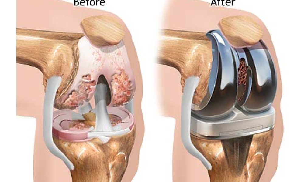 Knee Replacement Device Market