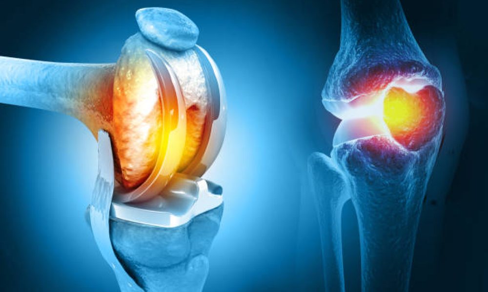 Human knee replacement surgery. Knee joint treatment. Knee injury. 3d illustration
