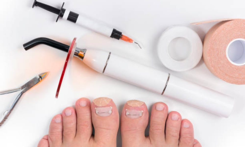 Рodologist (podiatrist) tools for titanium thread for nails. Polymerization UV lamp, tweezers, flowable composite gel, capolin, kinesiology tape and woman's feet. Isolated on white background. Ingrown and curled nails cure. Podology concept.