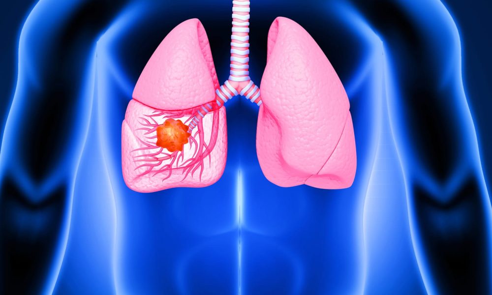 Lung Cancer Surgery Market