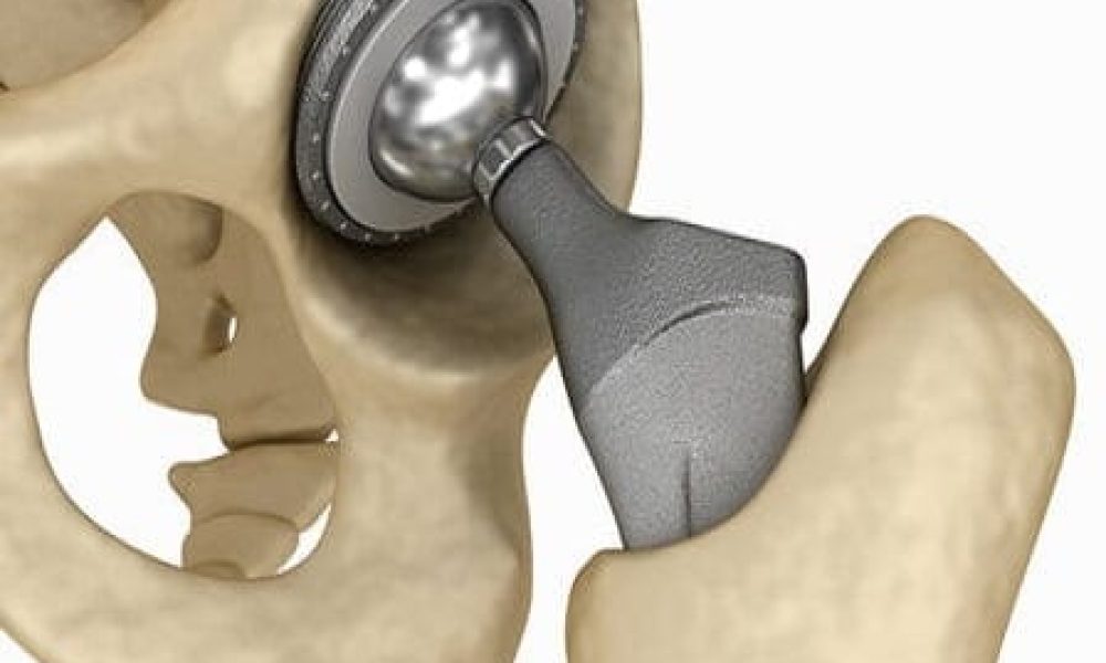 Medical Implants Market: A Compelling Long-Term Growth Story - Newstrail