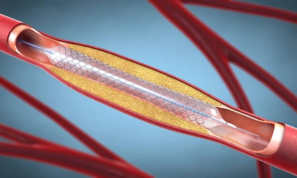 Medical Metal Tubing Market