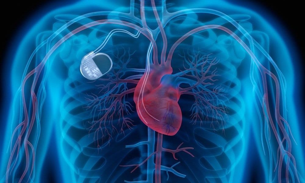 Medical Pacemaker Market to see Huge Growth by 2029: Osypka, Sorin ...