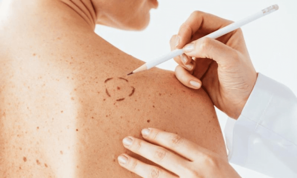 Melanoma Diagnostic and Therapeutic Market
