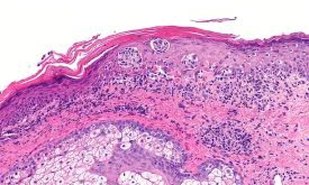 Melanoma Drugs Market