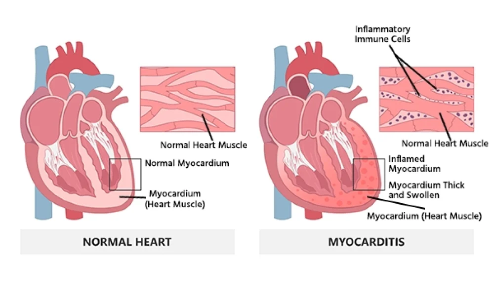 Myocarditis Treatment Market