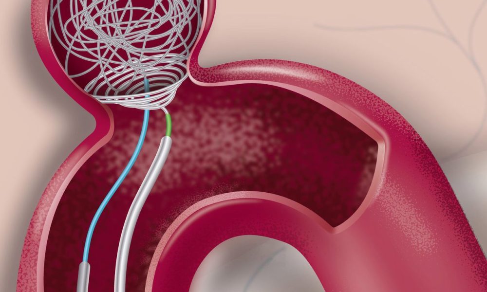 Neuroendovascular Non-Coils Market