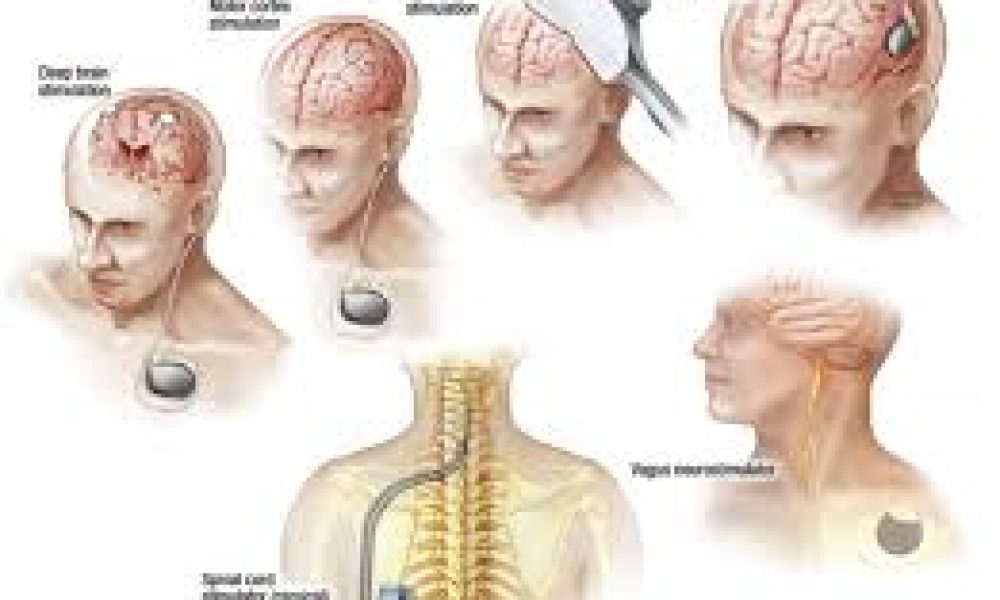 Neurostimulator Device Market Set for Explosive Growth |Cyberonics ...