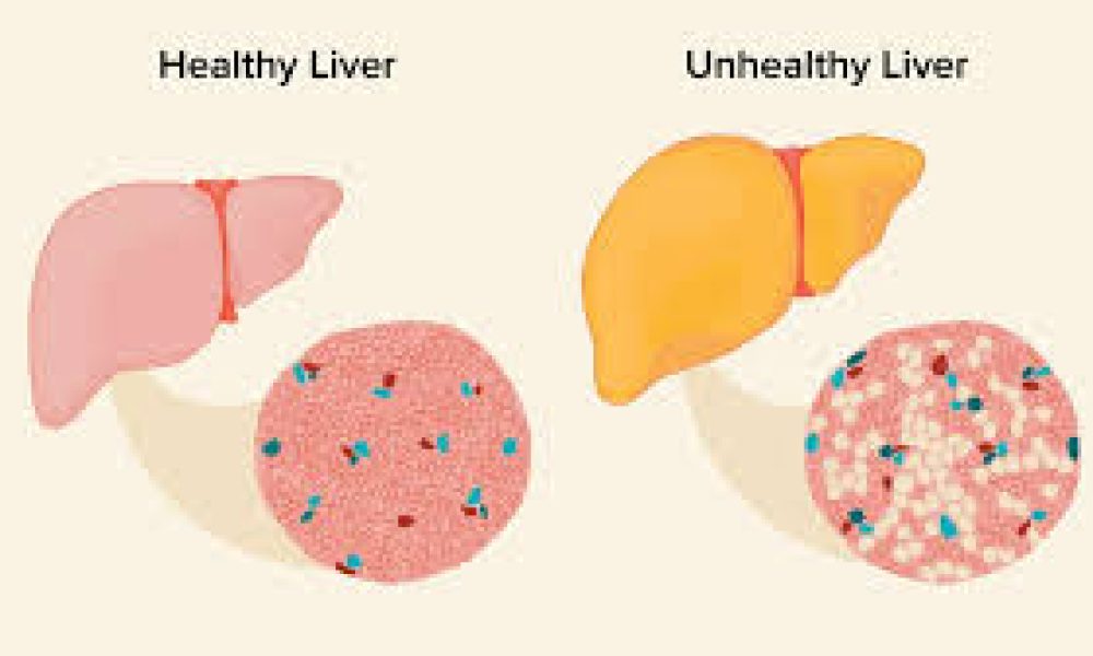 Nonalcoholic Steatohepatitis