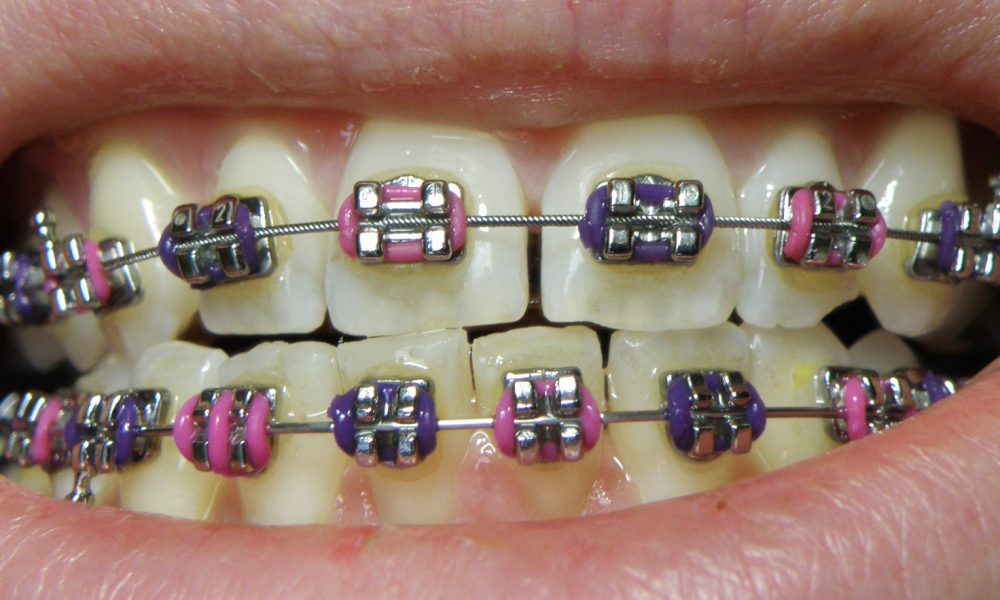 Orthodontic Braces Market