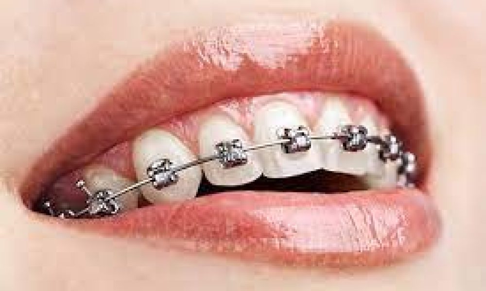 Global Orthodontic Brackets Market
