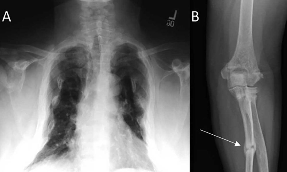 Tumour-Induced Osteomalacia Market