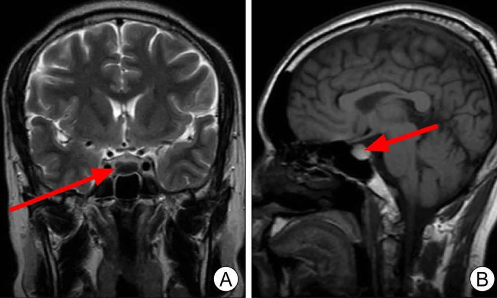 Pituitary Stalk Interruption Syndrome Treatment Market
