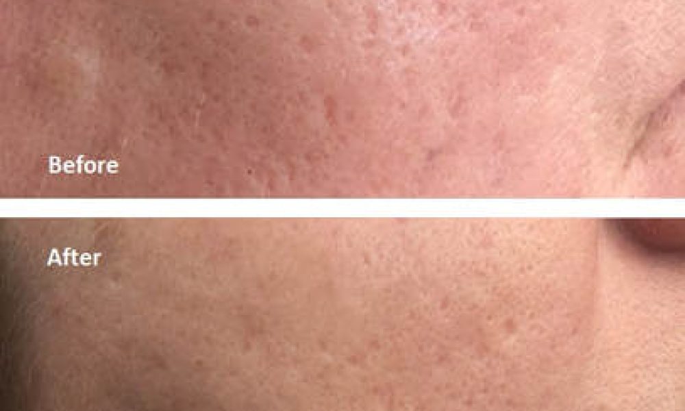 Post-Acne Scar Remediation Market