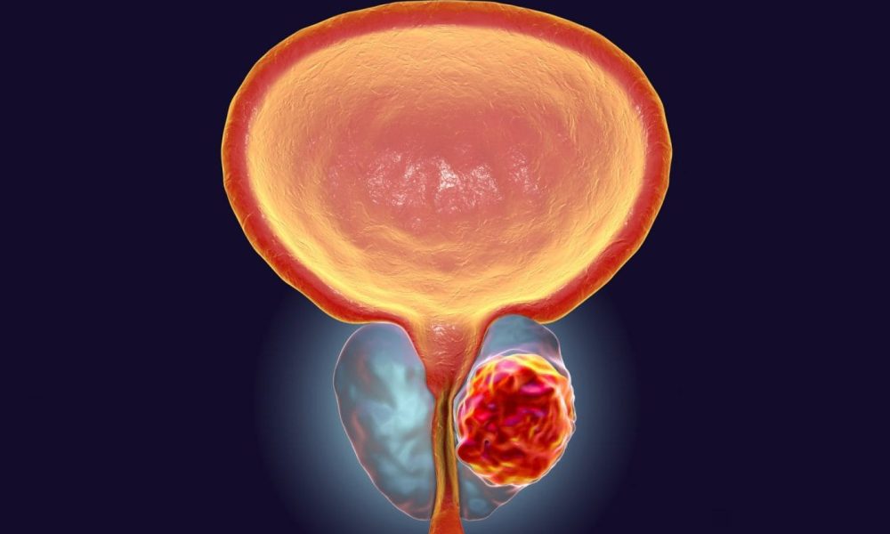 Prostate Cancer Market