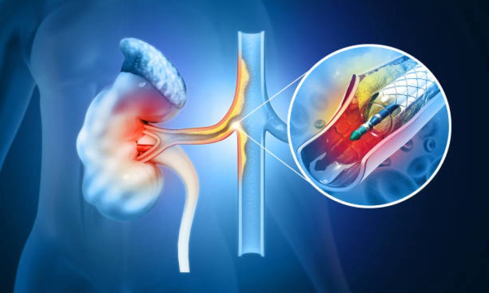 Stent angioplasty. Renal artery disease. Atherosclerosis progression at the end blocked blood flow. Diseased kidney. 3d illustration