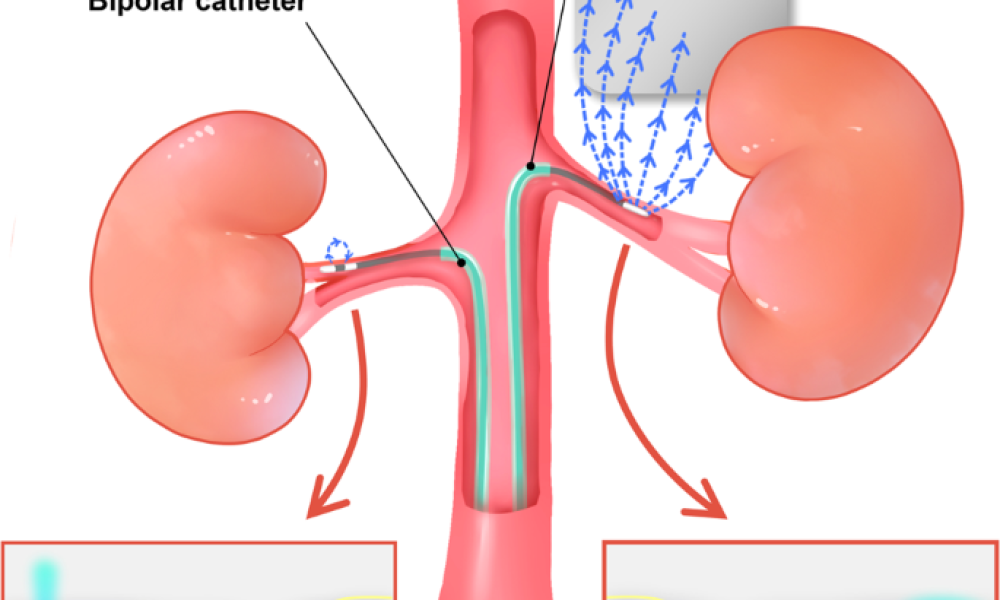 Renal Denervation