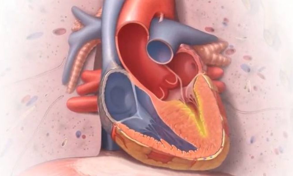 Restrictive Cardiomyopathy Treatment Market