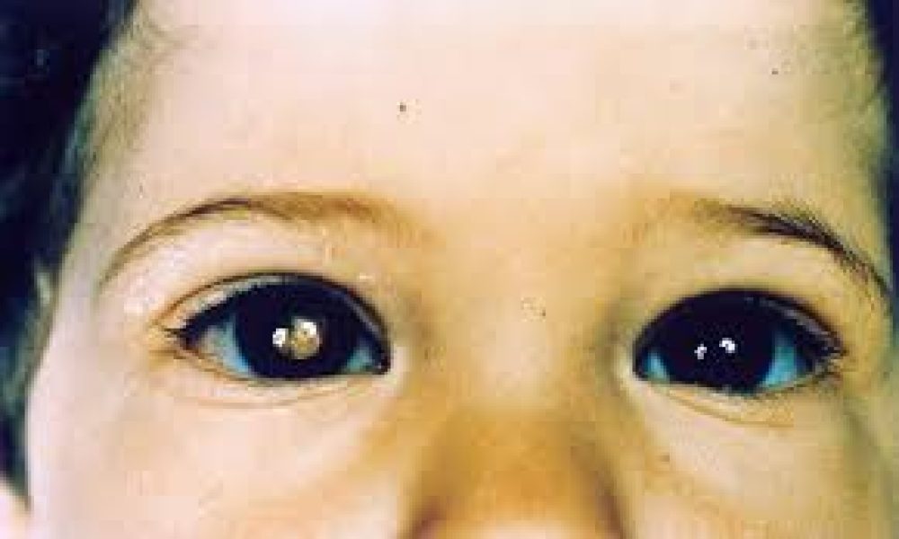 Retinoblastoma Treatment