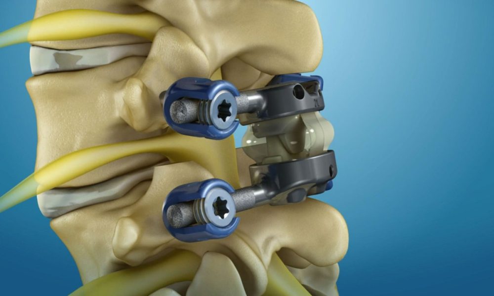 Spinal Implant Market Regaining Its Glory Medtronic, Zimmer Biomet