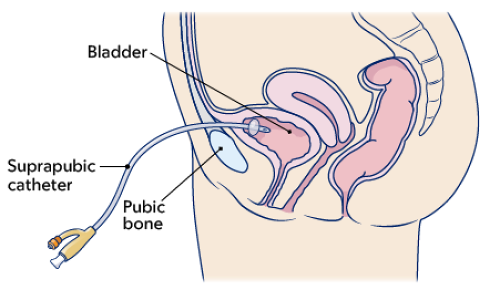 Suprapubic Catheter Market