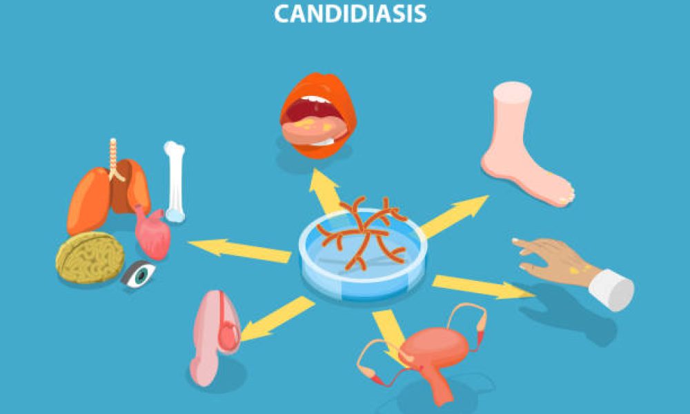 3D Isometric Flat Vector Illustration of Candidiasis, Medical Infographics