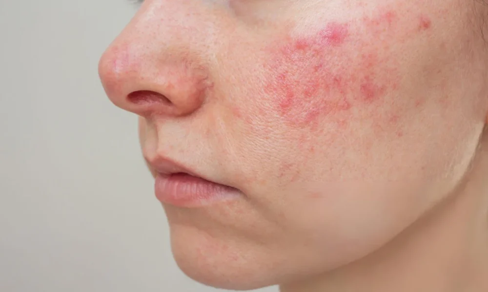 Systemic Lupus Erythematosus