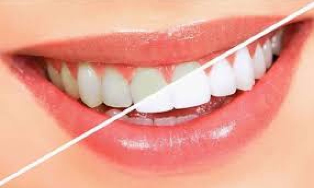 Teeth Whitening Products