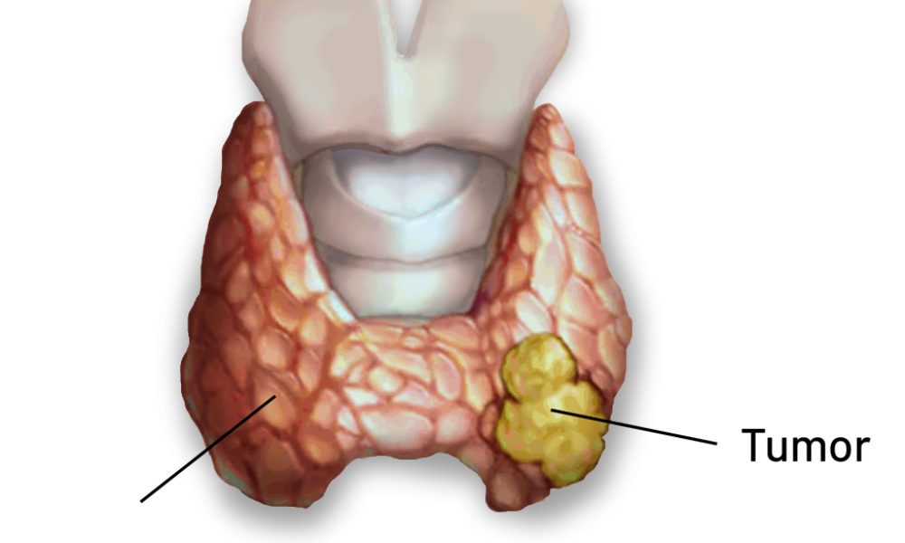 Thyroid Cancer Diagnostics Market