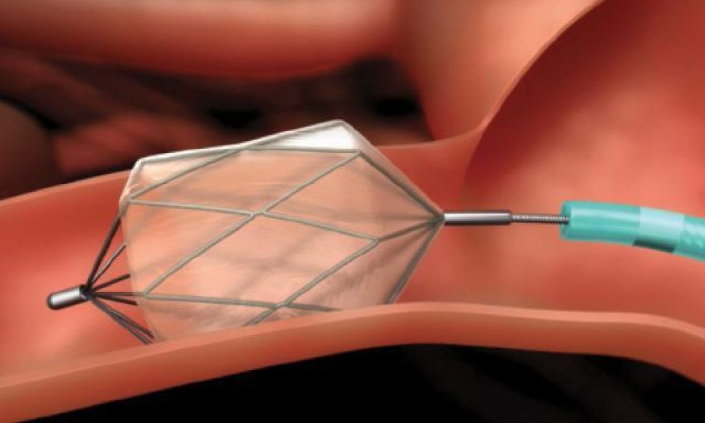 Transcatheter Embolization Device Market Rapidly Gaining Traction in ...