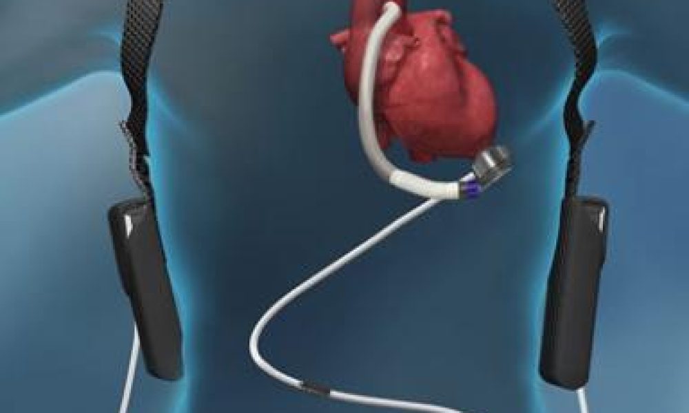 Ventricular Assist Device Market