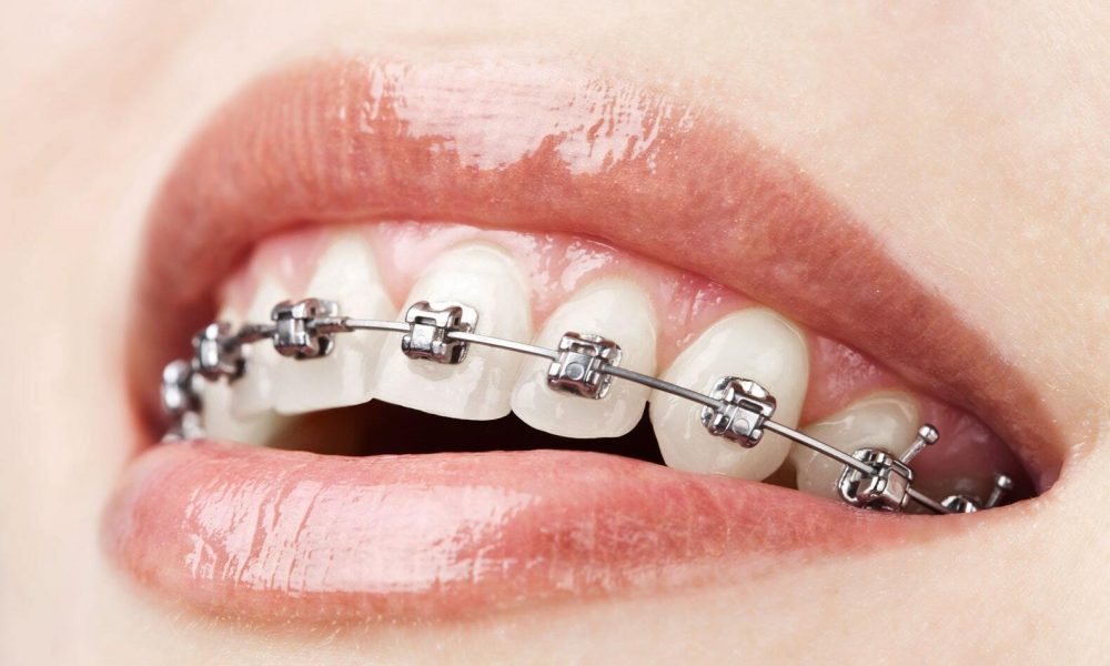 Walking Braces Market
