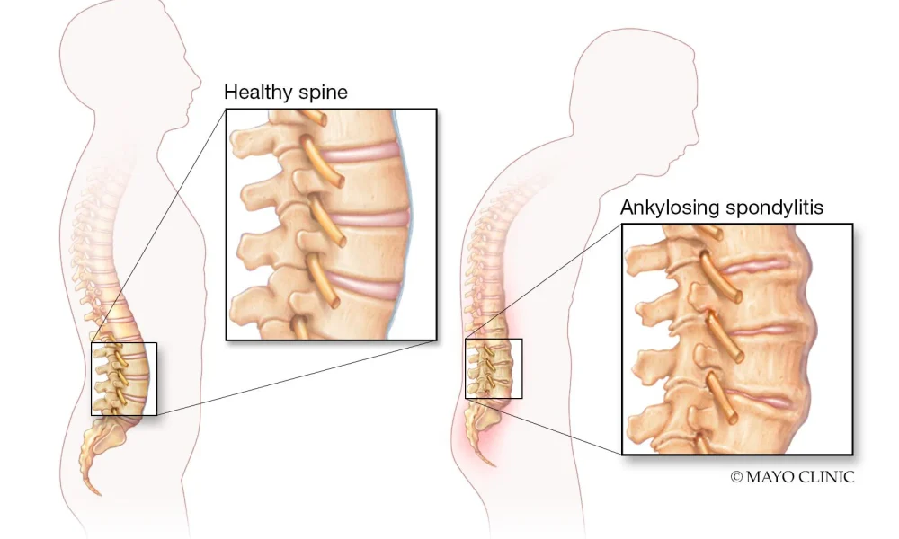 Ankylosing Spondylitis Market