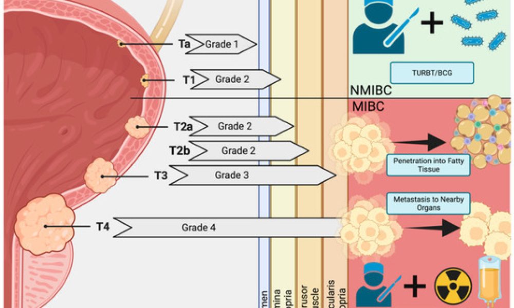 Non-muscle Invasive Bladder Cancer Therapeutics Market Set for Strong ...