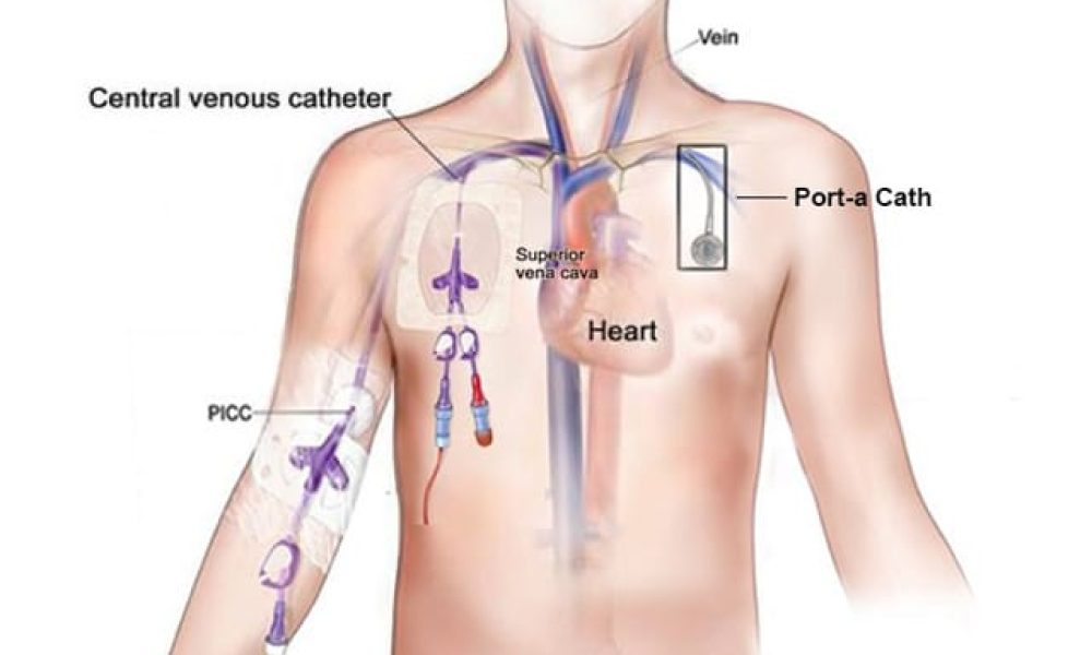 Venous Device Market