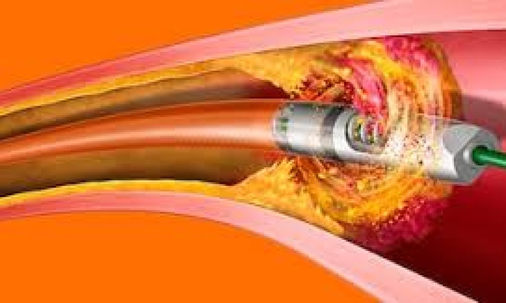 Atherectomy and Thrombectomy Devices Market