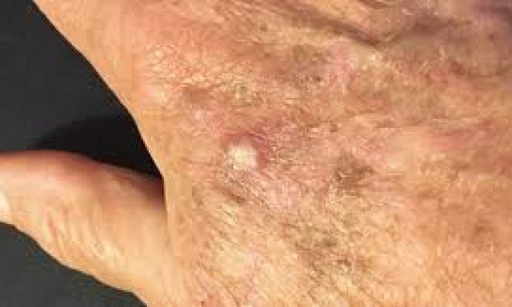 Actinic Keratosis Treatment Market