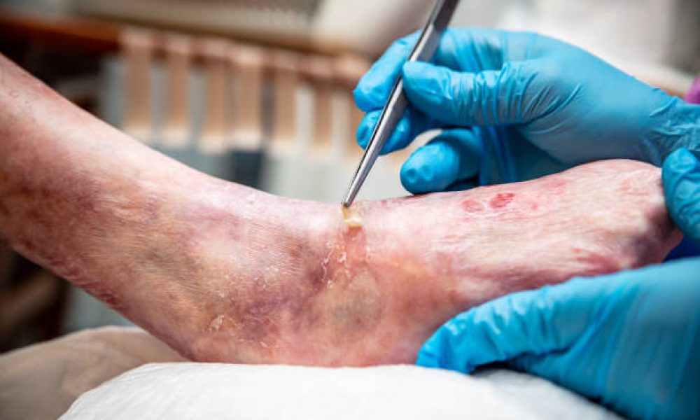 Diabetic Foot Ulcers Treatment Market