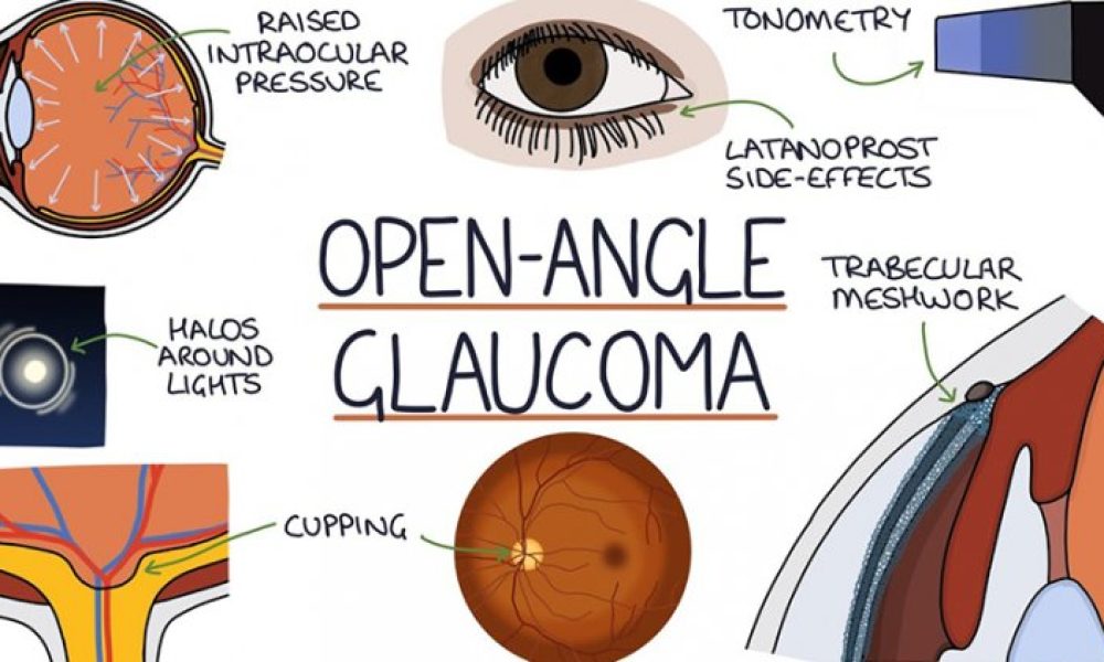 Open-Angle Glaucoma Therapeutics Market